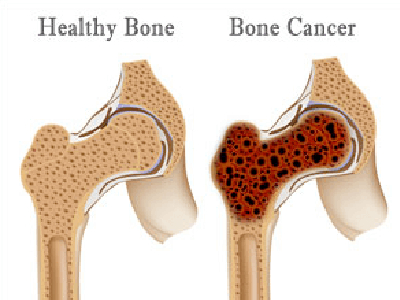 Bone Cancer Treatment In Brazil
